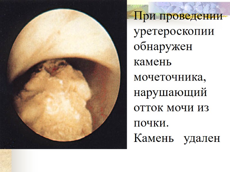 При проведении уретероскопии обнаружен камень мочеточника,  нарушающий отток мочи из почки. Камень 